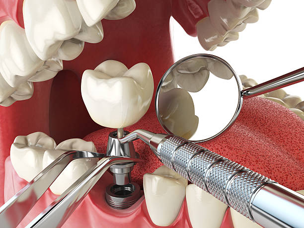 Best Emergency Tooth Extraction in Guymon, OK