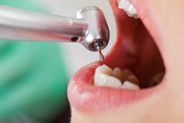 Best Emergency Tooth Extraction in Guymon, OK